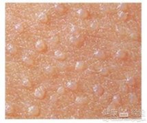 西寧哪家醫院看扁平疣比較好