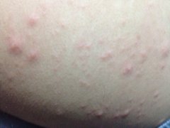 西寧看皮炎的醫(yī)院哪家好